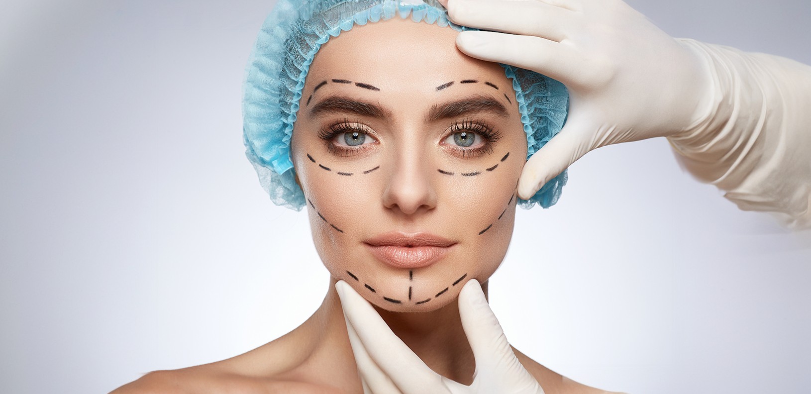 Non-surgical face sculpting with fillers