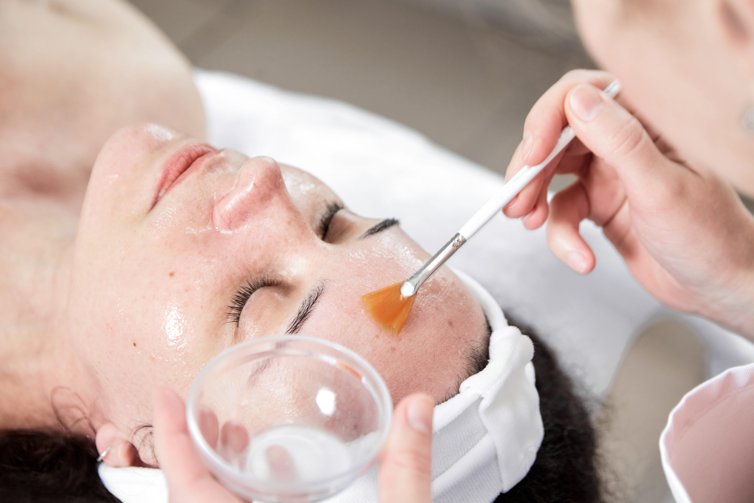 Chemical Peels Exfoliation