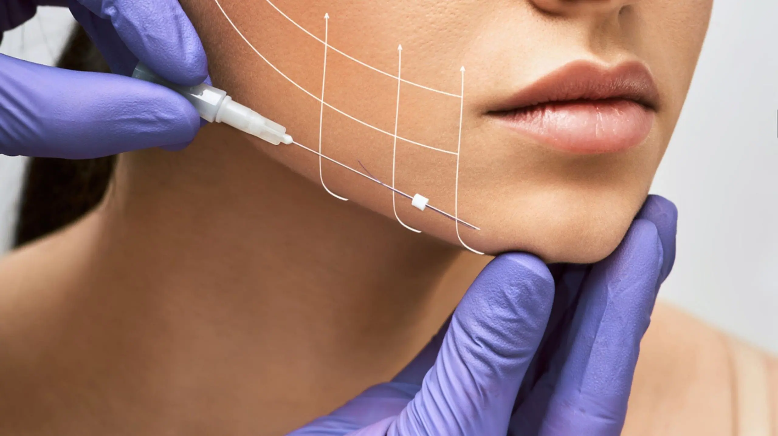 PDO thread lift facial tightening