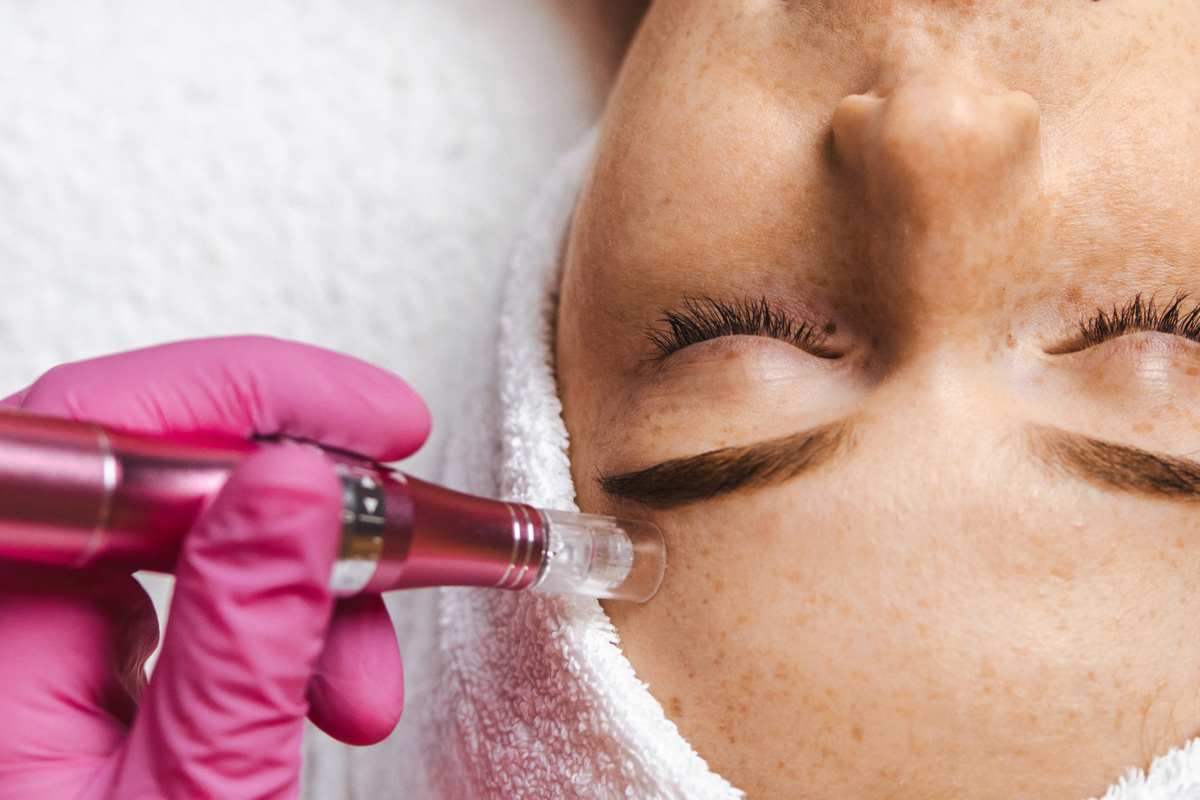 Microneedling Collagen Induction