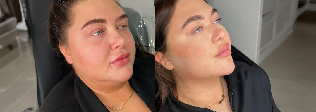 Fat Dissolving Injections treatment