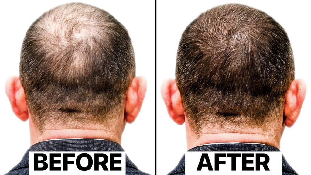 Exosomes Hair Treatment