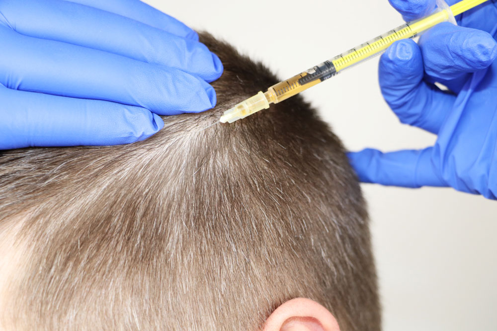 Hair mesotherapy scalp injection treatment