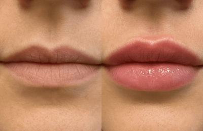 Exosomes for Lips regenerative treatment