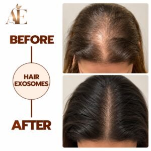 Hair exosome treatment before and after session at Aesthetics Studio by Escobar in Rawalpindi